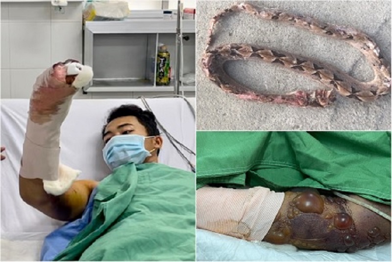 Bệnh viện tiếp nhận 2 bệnh nhân bị rắn độc cắn